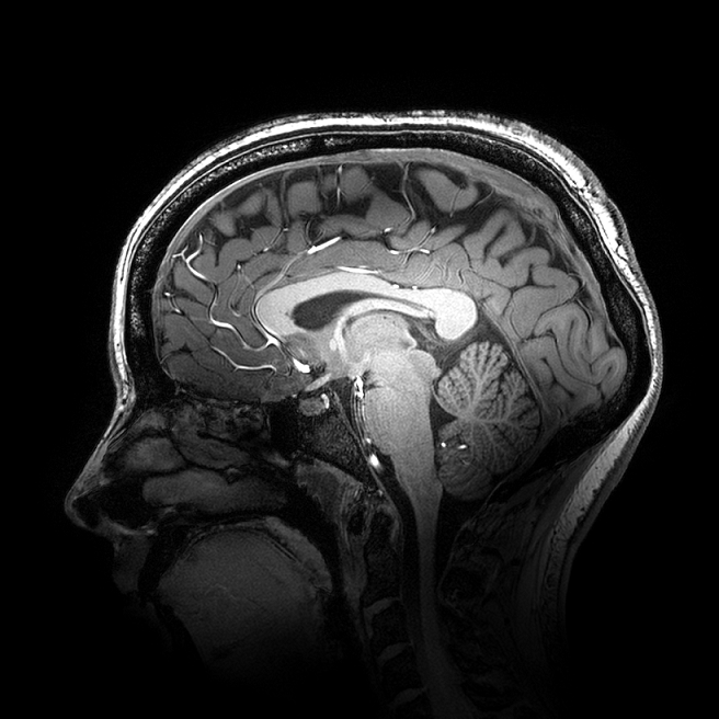 新型MRI技术改善了严重抑郁症治疗的持久效果