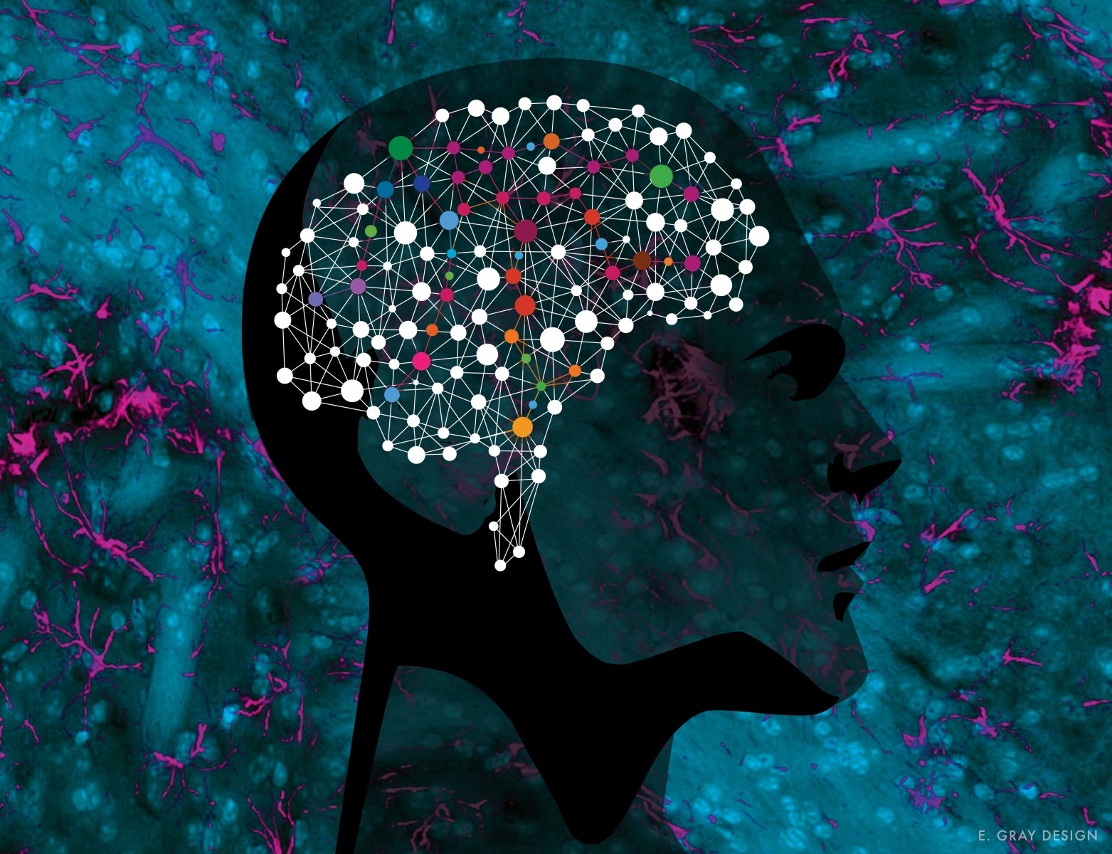 研究人员发现新型遗传性脑疾病