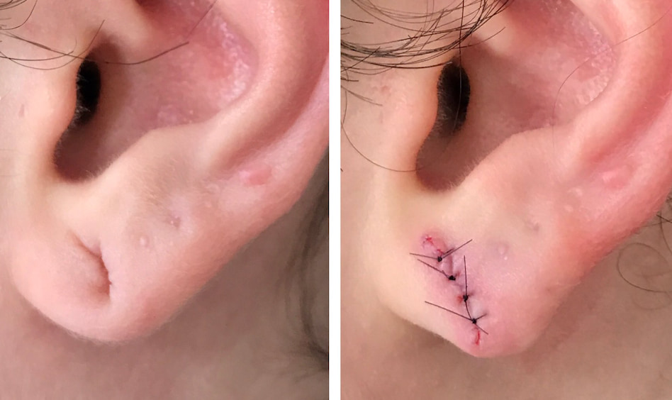 ear piercing surgical repair